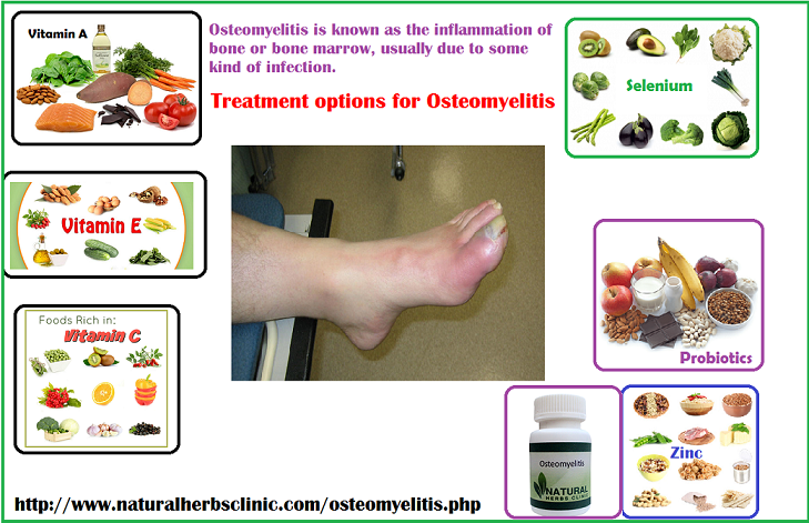 Treatment for Osteomyelitis 