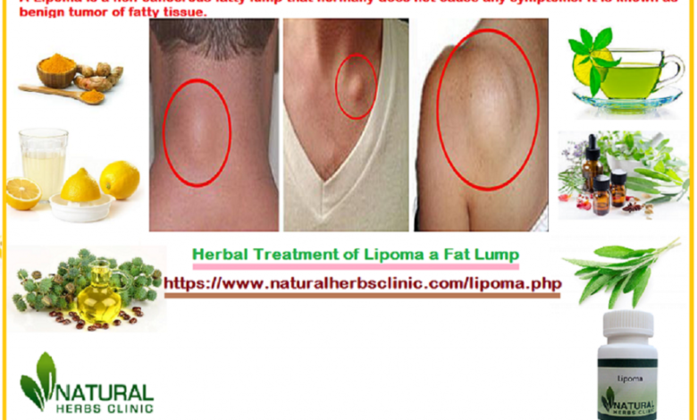 Herbal-Treatment-of-Lipoma-a-Fat-Lump-1-1024x662