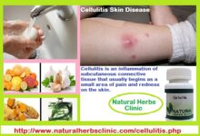Treatment-of-Cellulitis-Skin-Infection