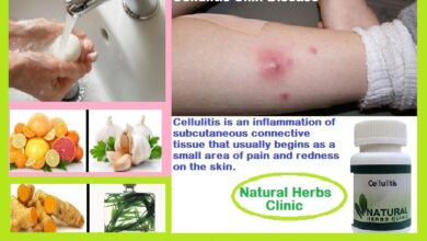 Treatment-of-Cellulitis-Skin-Infection