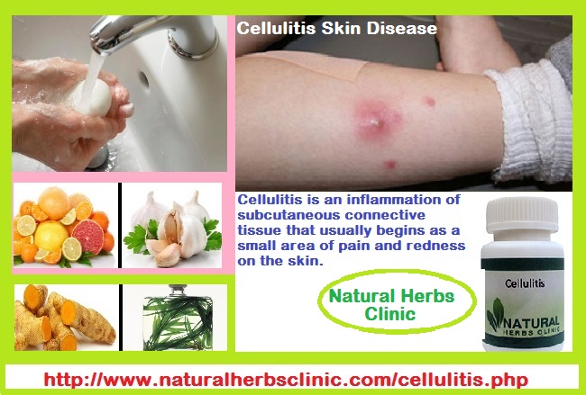 Cellulitis Treatment Cellulitis Treatment