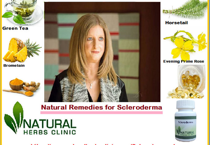 4-Natural-Remedies-for-Scleroderma