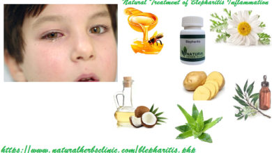 Natural-Treatment-of-Blepharitis-Inflammation-of-the-Eyelids-1