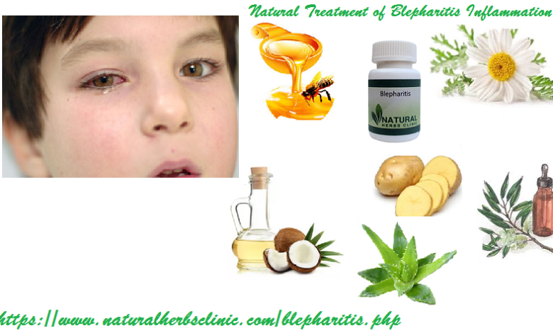 Natural-Treatment-of-Blepharitis-Inflammation-of-the-Eyelids-1