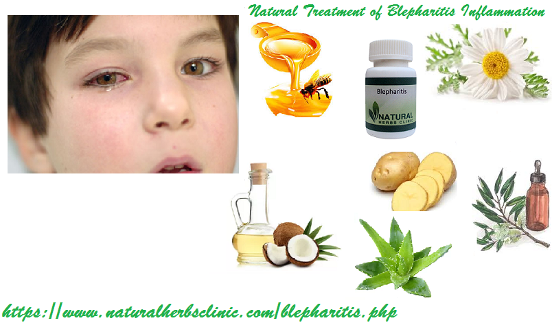 Blepharitis Natural Treatment