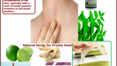 Prickly-Heat-Home-Remedies