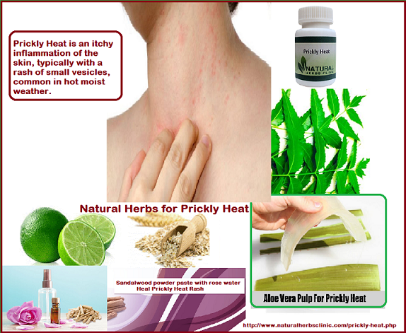 Prickly-Heat-Home-Remedies