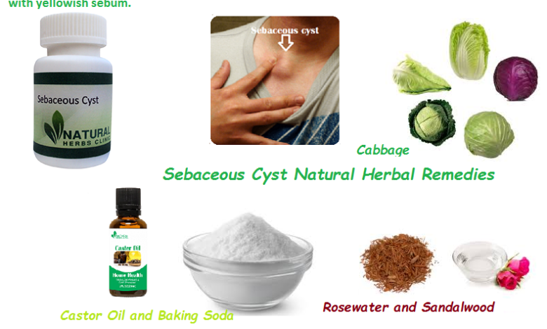 Sebaceous-Cyst-Natural-Herbal-Remedy