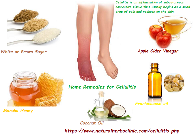 Natural-Remedy-for-Cellulitis