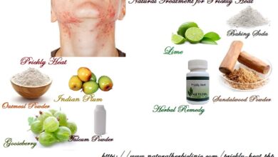 Natural-Treatment-for-Prickly-Heat