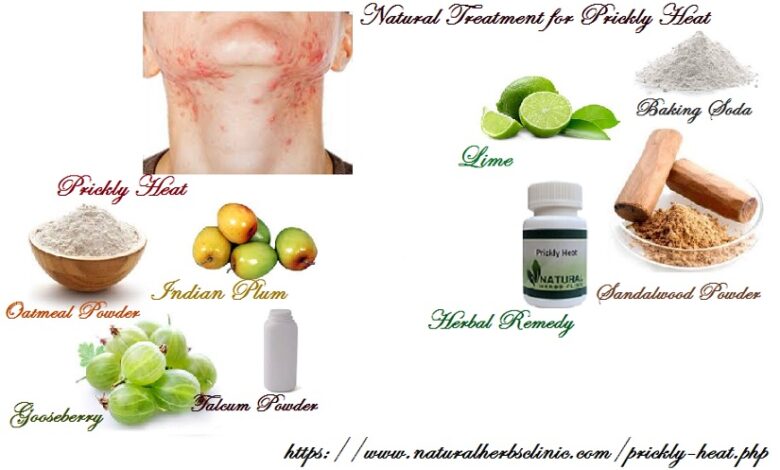 Natural-Treatment-for-Prickly-Heat