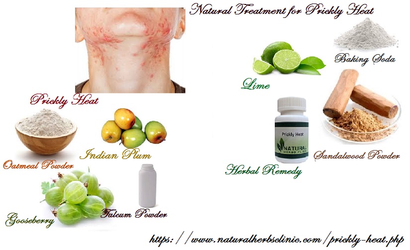 Herbal Remedies for Prickly Heat Causes, Symptoms, Treatment