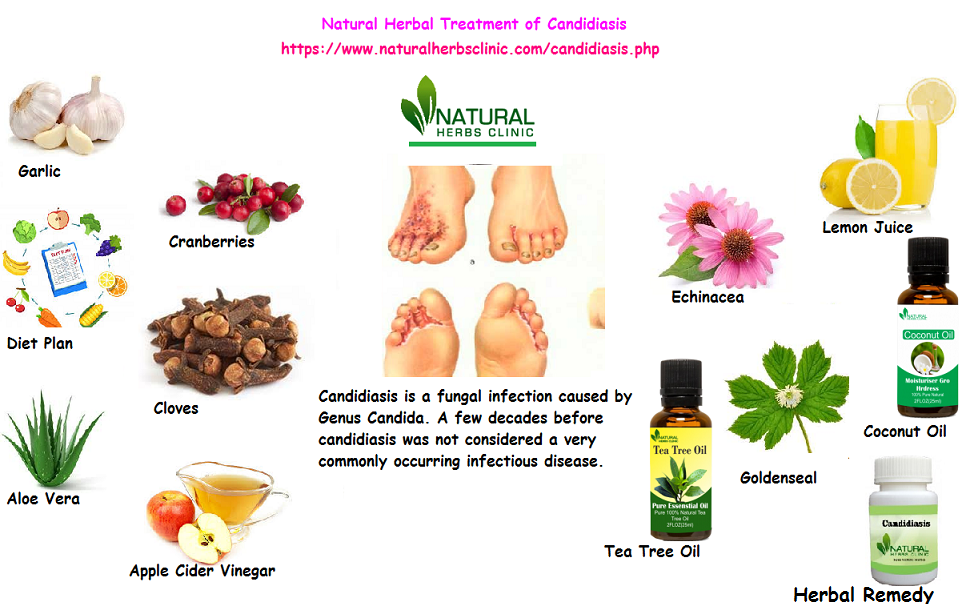 Natural Herbal Treatment of Candidiasis