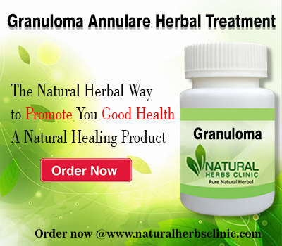 Granuloma-Annulare-Herbal-Treatment