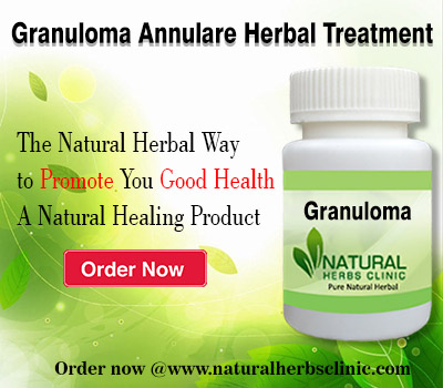 Natural Remedies for Granuloma Annulare