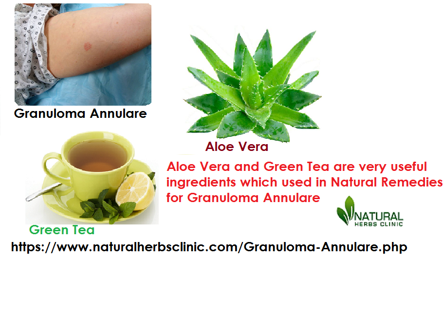Aloe vera and green tea for Natural Remedies for Granuloma Annulare