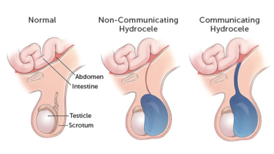 hydrocele 1