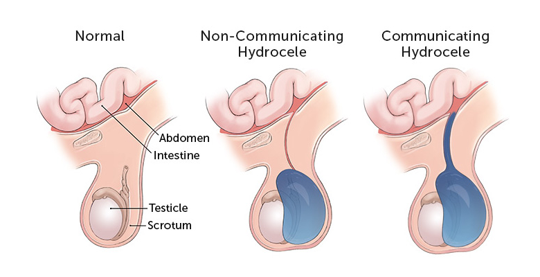 hydrocele 1