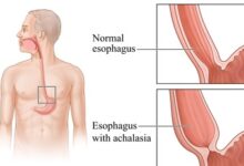 Achalasia