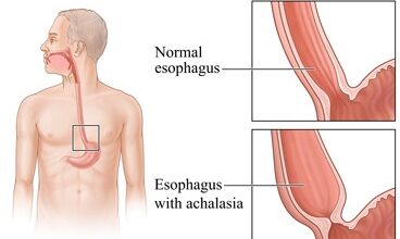 Achalasia