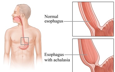 Achalasia