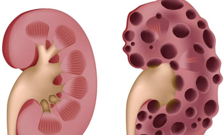 Polycystic-Kidney-Disease