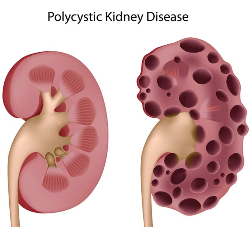 Polycystic Kidney Disease
