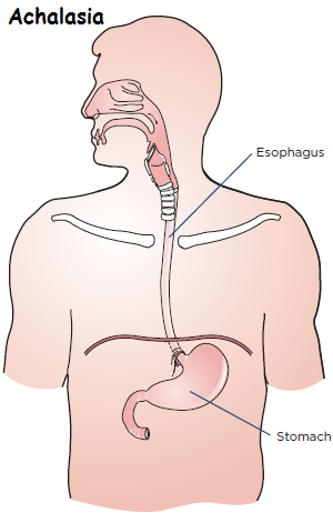 Natural-Remedies-for-Achalasia-to-Decrease-the-Symptoms