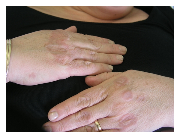 Natural Remedies for Granuloma Annulare Inflammatory Rash Skin Issues img