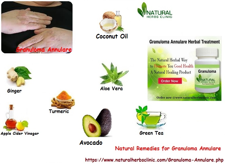 Natural Remedies for Granuloma Annulare