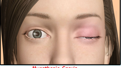 Myasthenia-Gravis