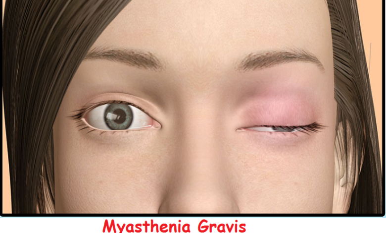 Myasthenia-Gravis