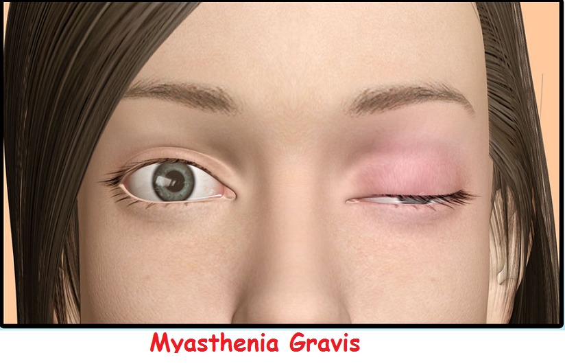 5 Useful Natural Remedies for Myasthenia gravis to Lessen the Symptoms