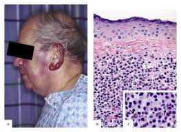 Utilize Natural Remedies for Waldenstrom’s Macroglobulinemia img