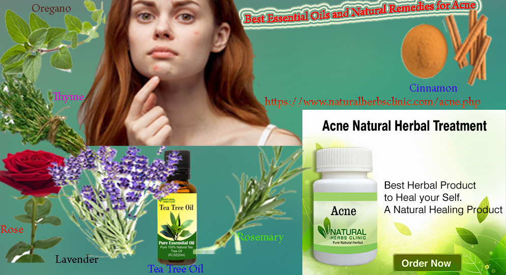 Natural Remedies for Acne