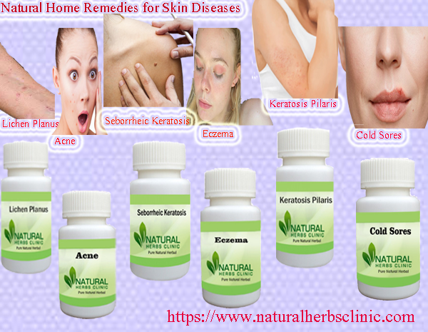 Natural Home Remedies for Skin Disease