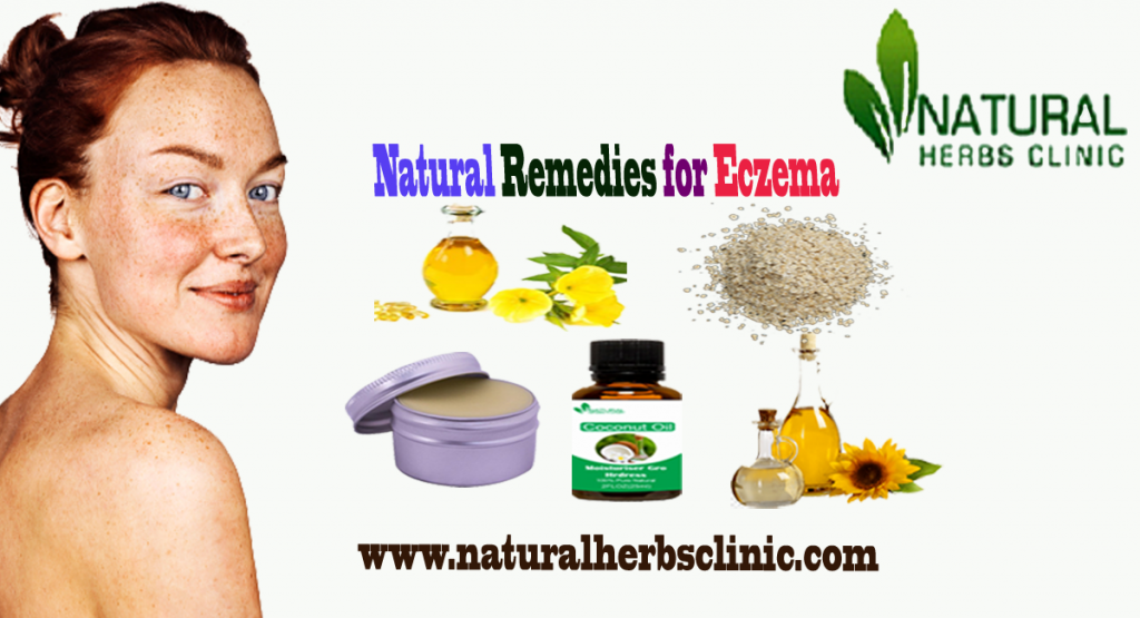 Natural Remedies for Eczema Natural Remedies for Eczema