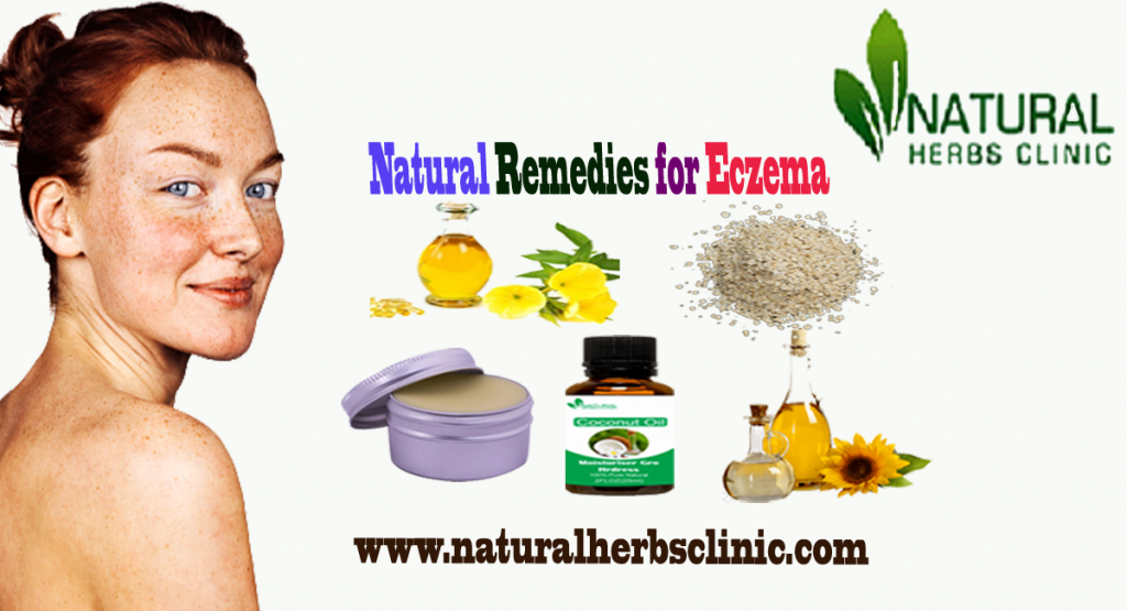 Natural Remedies for Eczema