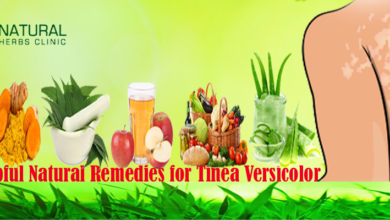 Apply-Helpful-Natural-Remedies-for-Tinea-Versicolor