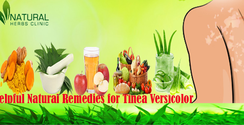 Apply-Helpful-Natural-Remedies-for-Tinea-Versicolor