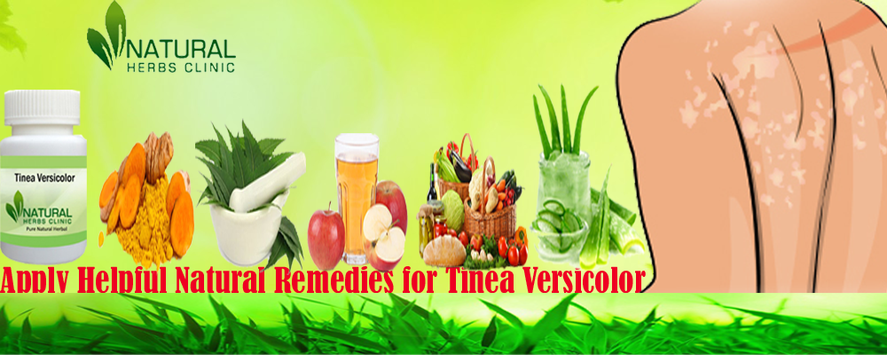 Natural Remedies for Tinea Versicolor