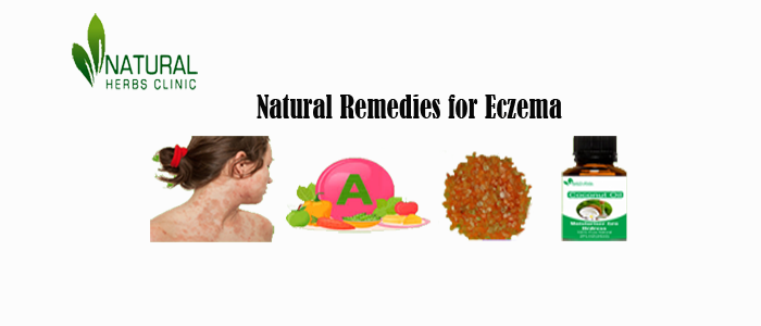 Herbal Treatment for Eczema Herbal Treatment for Eczema