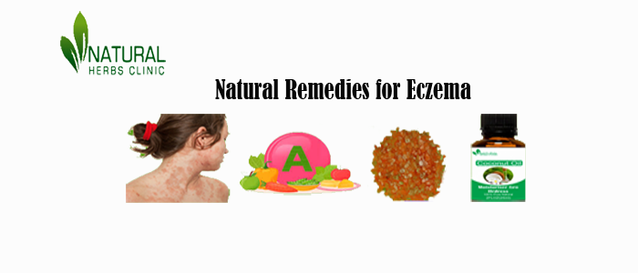 Herbal Treatment for Eczema