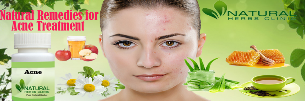 Natural Remedies for Acne