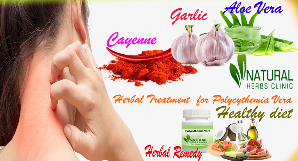 Herbal Treatment for Polycythemia Vera