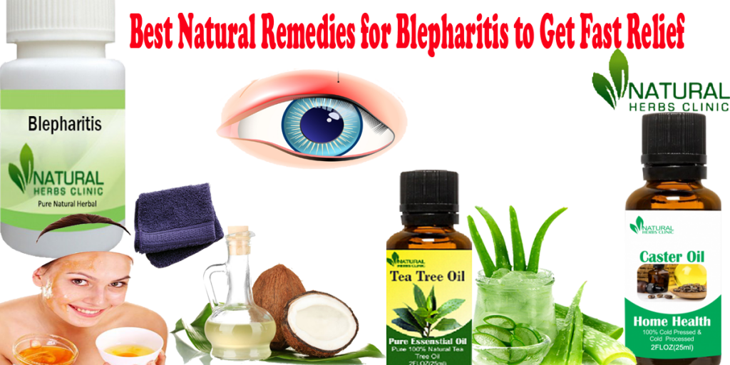 Best Natural Remedies for Blepharitis to Get Fast Relief