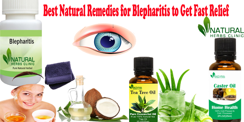 Natural Remedies for Blepharitis