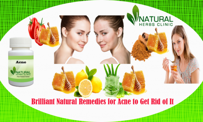 Natural-Remedies-for-Acne-1024x585