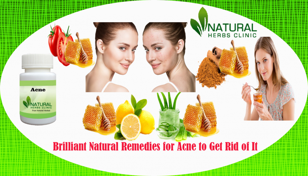 Natural Remedies for Acne Natural Remedies for Acne
