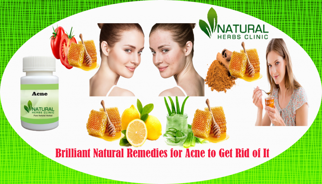 Natural Remedies for Acne